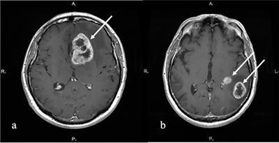 The Role of 3D-pCASL MRI in the Differential Diagnosis of Glioblastoma and Brain Metastases